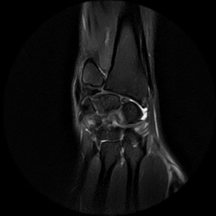 Volar intercalated segmental instability (VISI) | Image | Radiopaedia.org