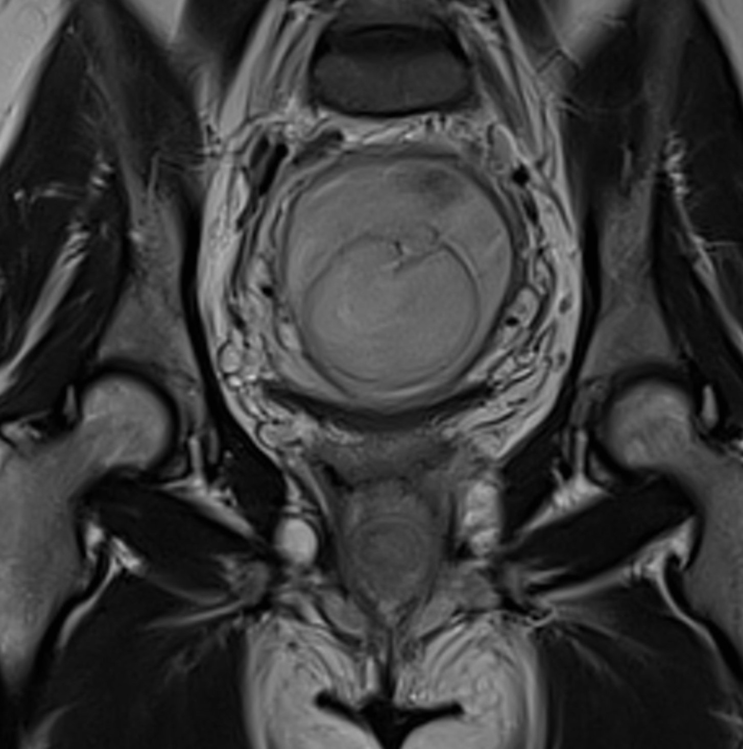 Skene duct abscess | Image | Radiopaedia.org