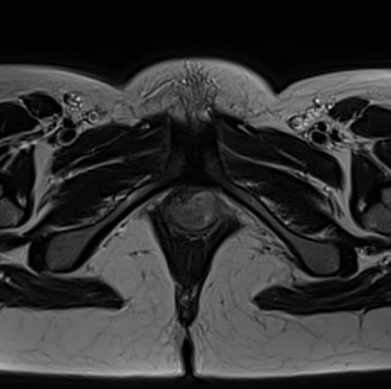 Skene duct abscess | Image | Radiopaedia.org