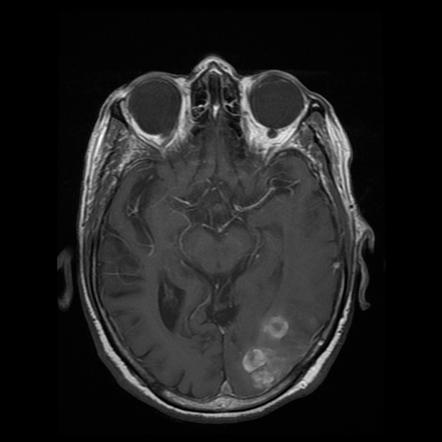 Cerebral amyloid angiopathy with multifocal lobar hemorrhages | Image ...