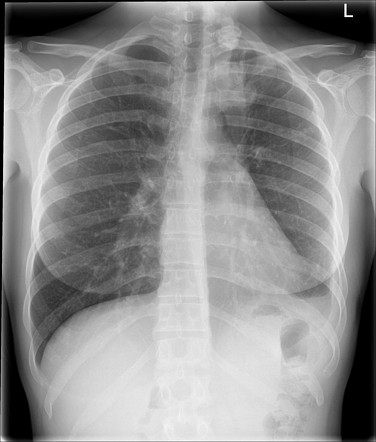 Pulmonary tuberculosis | Radiology Case | Radiopaedia.org