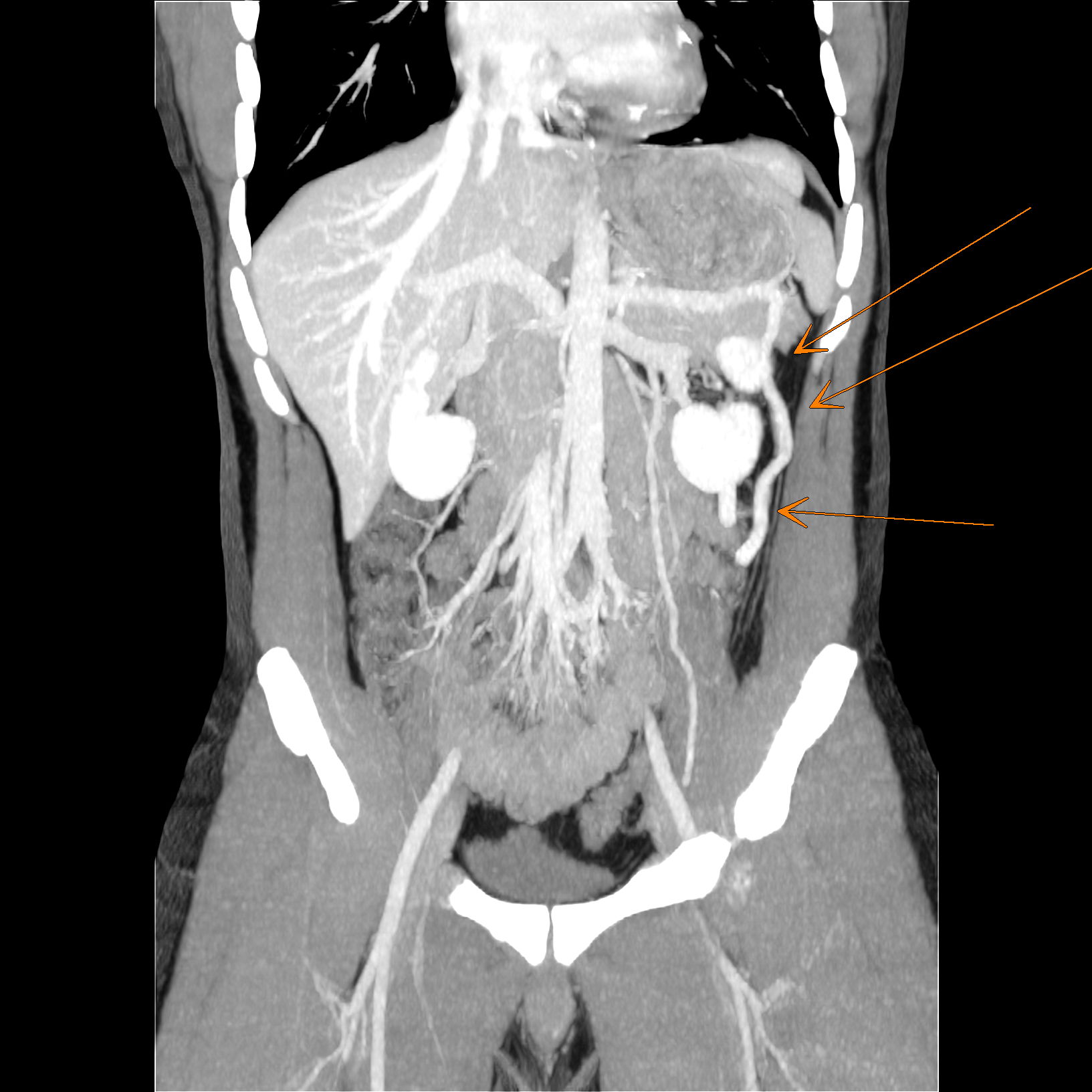 Nutcracker syndrome (annotated CT) Image