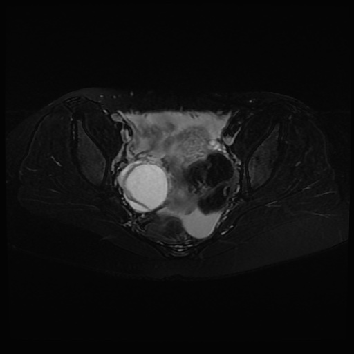 Ruptured ovarian hemorrhagic cyst | Image | Radiopaedia.org