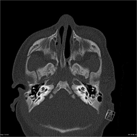 Choanal atresia | Radiology Reference Article | Radiopaedia.org