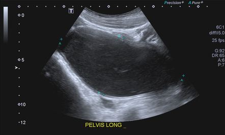 Hematocolpos | Radiology Reference Article | Radiopaedia.org