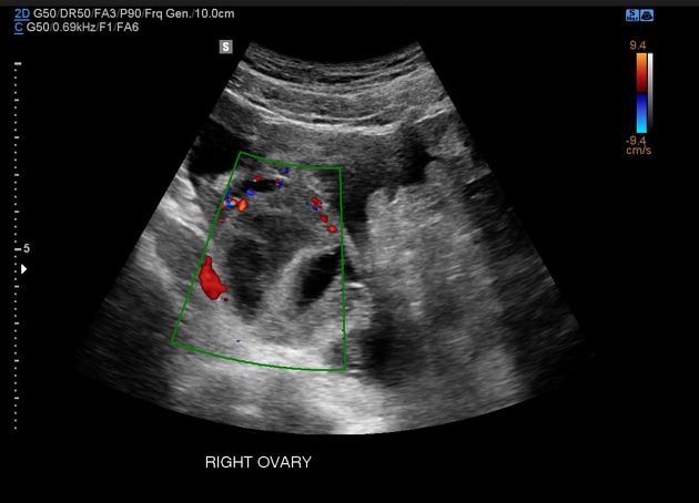 Hemorrhagic corpus luteal cyst  Radiology Reference Article