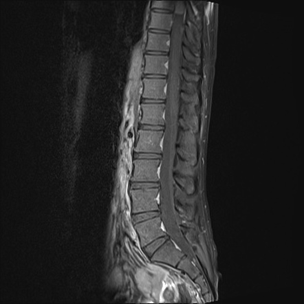 Solitary fibrous tumor of the dura | Image | Radiopaedia.org