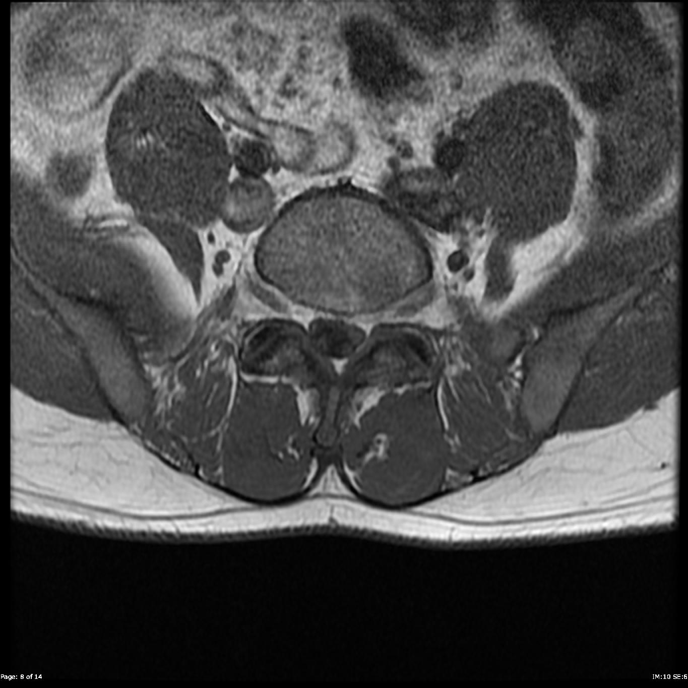 Normal Spinal Mri