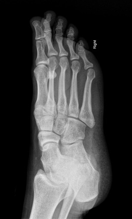 Avulsion fracture of the 5th metatarsal styloid | Radiology Reference ...