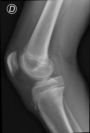 Osgood-Schlatter disease | Radiology Case | Radiopaedia.org