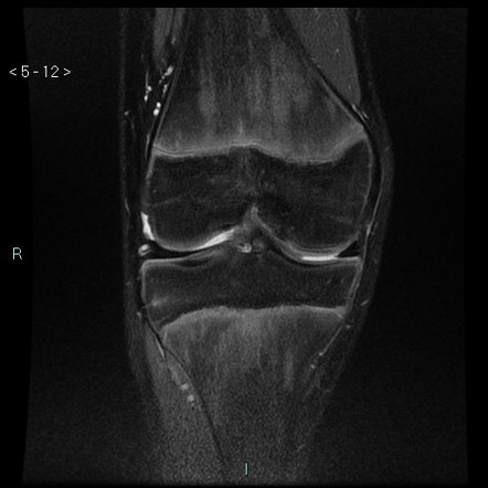 Osgood-Schlatter disease | Image | Radiopaedia.org