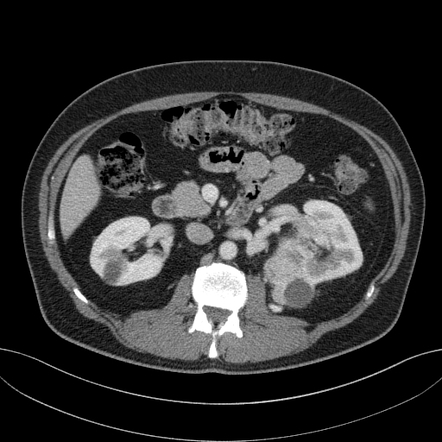 Clear cell renal cell carcinoma | Radiology Reference Article ...