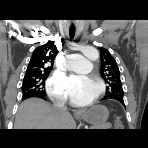 Congenitally corrected transposition of the great arteries (L-TGA) and ...