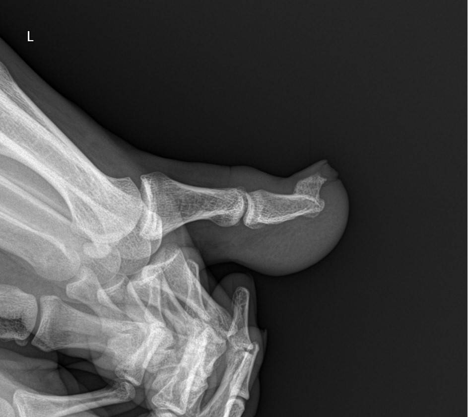 Subungual Exostosis Big Toe Image Radiopaedia Org