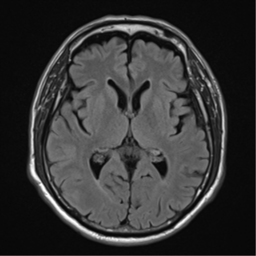 White epidermoid | Image | Radiopaedia.org