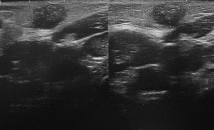 Pilomatricoma | Image | Radiopaedia.org