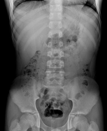 Hereditary spherocytosis | Radiology Case | Radiopaedia.org