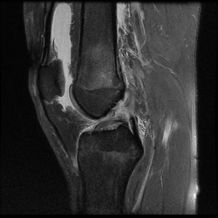 Anterior cruciate ligament tear | Radiology Case | Radiopaedia.org