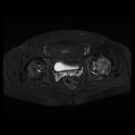 Avascular necrosis of the hip | Radiology Case | Radiopaedia.org