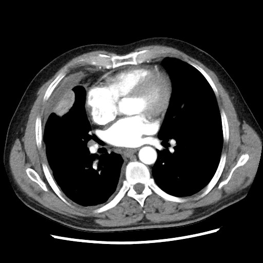 Round atelectasis | Image | Radiopaedia.org