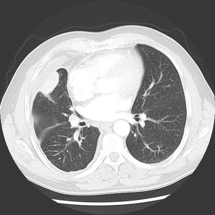 Round atelectasis | Image | Radiopaedia.org