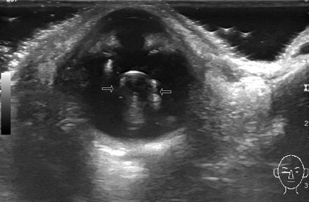 Dislocated intraocular lens | Radiology Case | Radiopaedia.org