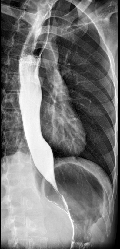 Achalasia - Timed Barium Esophagogram | Image | Radiopaedia.org