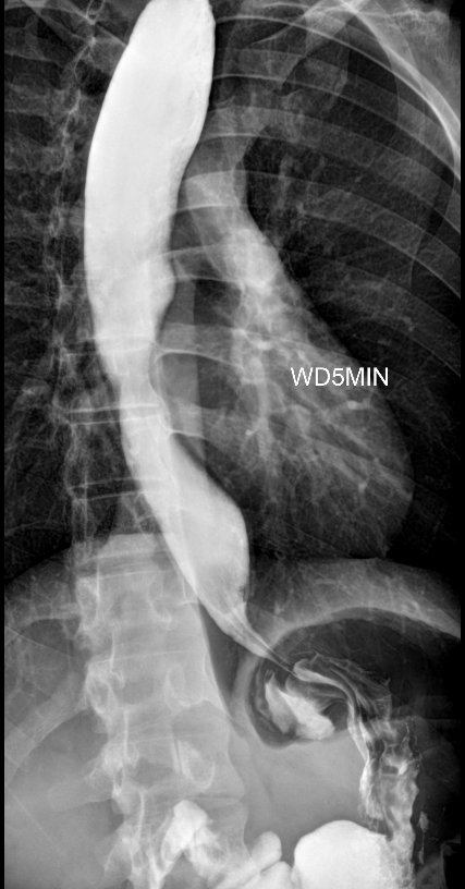 Achalasia - Timed Barium Esophagogram | Image | Radiopaedia.org