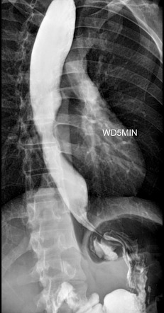 Timed Barium Esophagogram | Radiology Reference Article | Radiopaedia.org