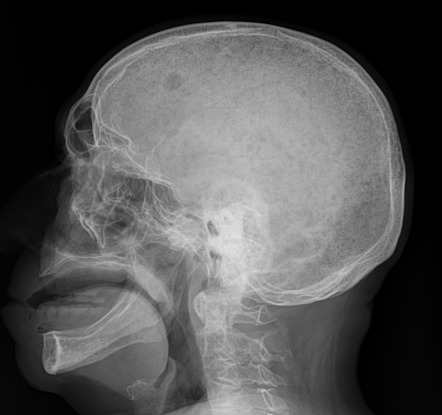 Raindrop skull | Radiology Reference Article | Radiopaedia.org