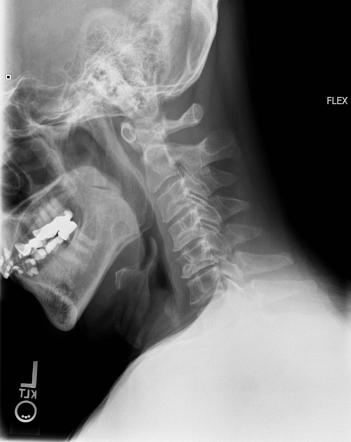 Stafne cyst | Image | Radiopaedia.org