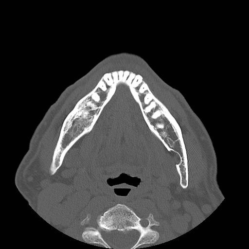 Stafne Cyst Image 6699