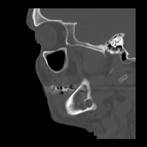 Stafne Cyst Image 0744