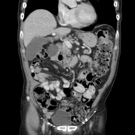 Synchronous colorectal carcinomas | Image | Radiopaedia.org