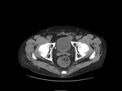 Urinary bladder hernia | Radiology Reference Article | Radiopaedia.org