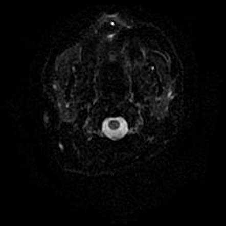 Cerebellopontine angle epidermoid cyst | Image | Radiopaedia.org