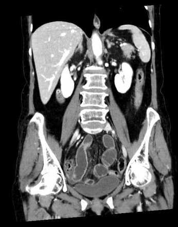 Gallstone ileus | Image | Radiopaedia.org