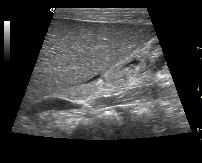 Bilateral Renal Cortical Calcification Image