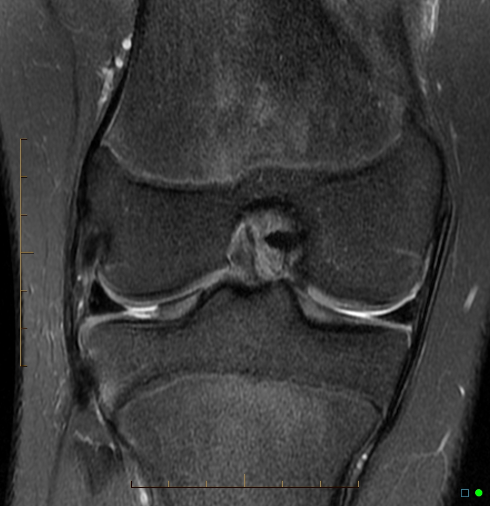 Chondral Defect | Image | Radiopaedia.org