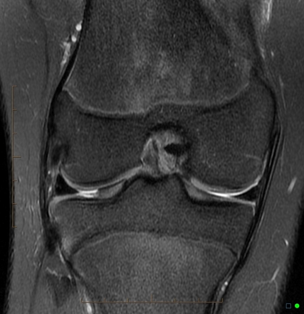 Chondral defect | Image | Radiopaedia.org