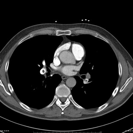 Pulmonary embolism | Radiology Case | Radiopaedia.org