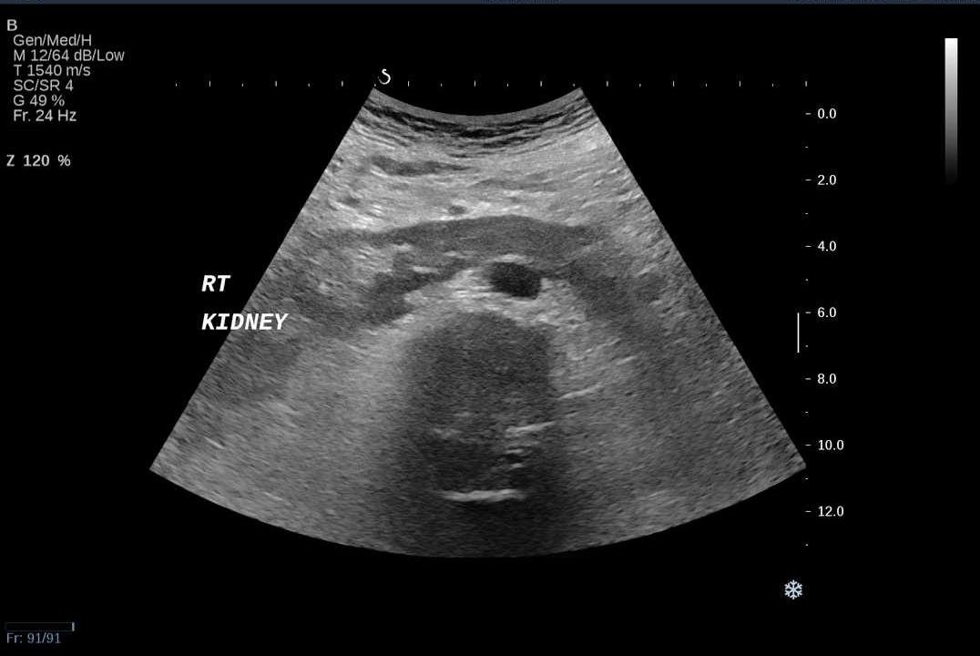 Unexpected colitis of the descending colon | Image | Radiopaedia.org