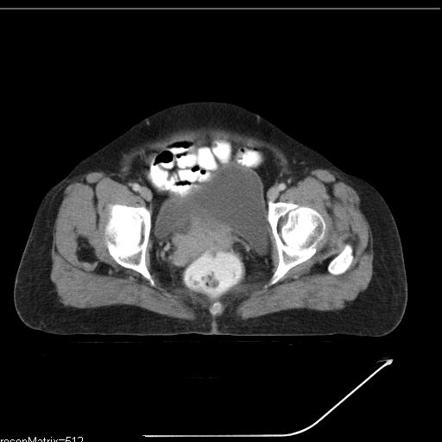 Carcinoma of the cervix | Radiology Reference Article | Radiopaedia.org