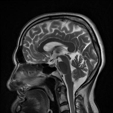 Dysembryoplastic neuroepithelial tumor (DNET) | Image | Radiopaedia.org