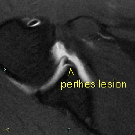 Perthes lesion | Radiology Case | Radiopaedia.org