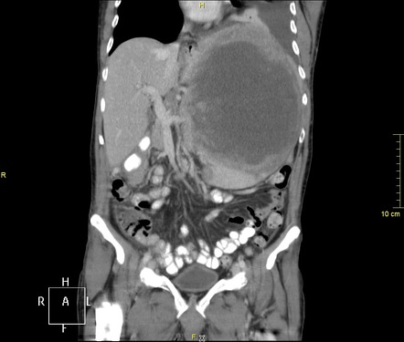 Splenic lymphoma | Radiology Reference Article | Radiopaedia.org