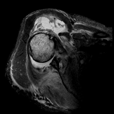 Glenohumeral Joint Effusion 