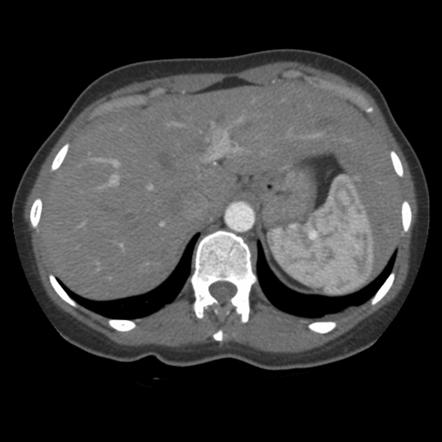 Spleen, Radiology Reference Article