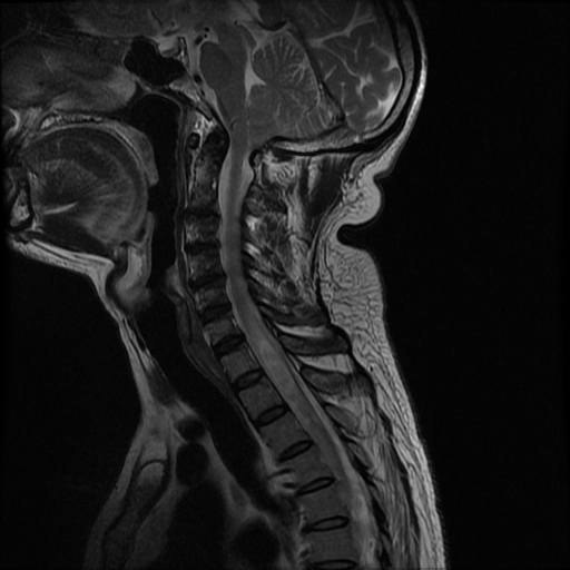 Charcot shoulder | Image | Radiopaedia.org