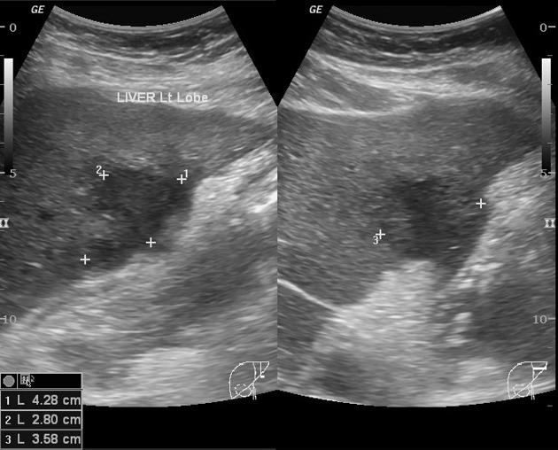 Hepatic abscess | Radiology Reference Article | Radiopaedia.org